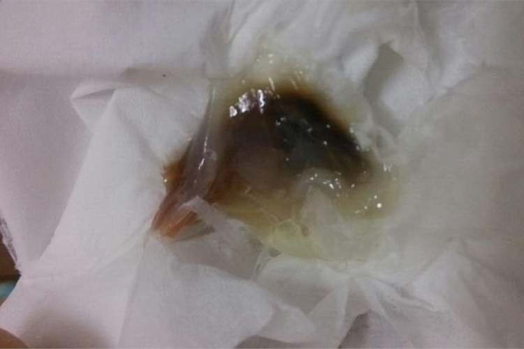 子宫肌瘤黑色白带图 子宫肌瘤黑色白带图