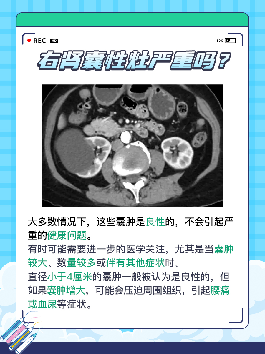 右肾囊性灶：这是否意味着严重健康问题？