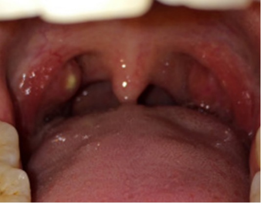 小儿喉咙有白色脓包图