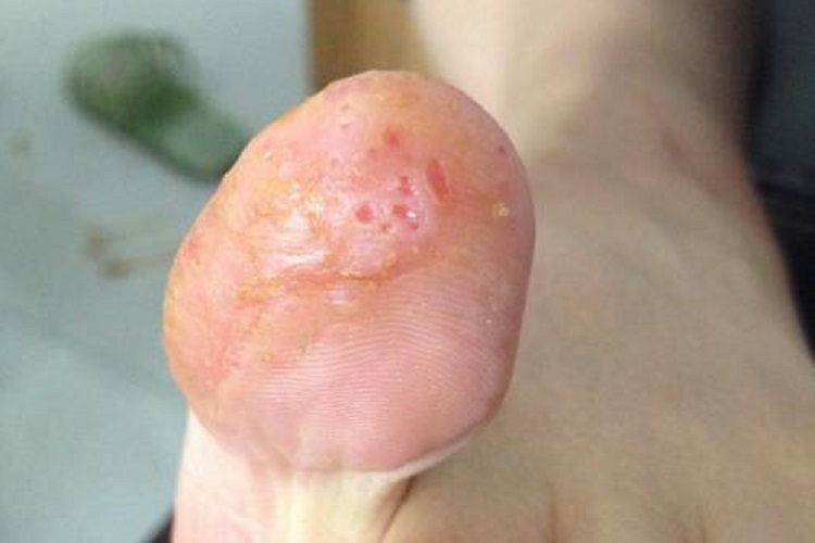 水疱型足癣脚趾小坑图