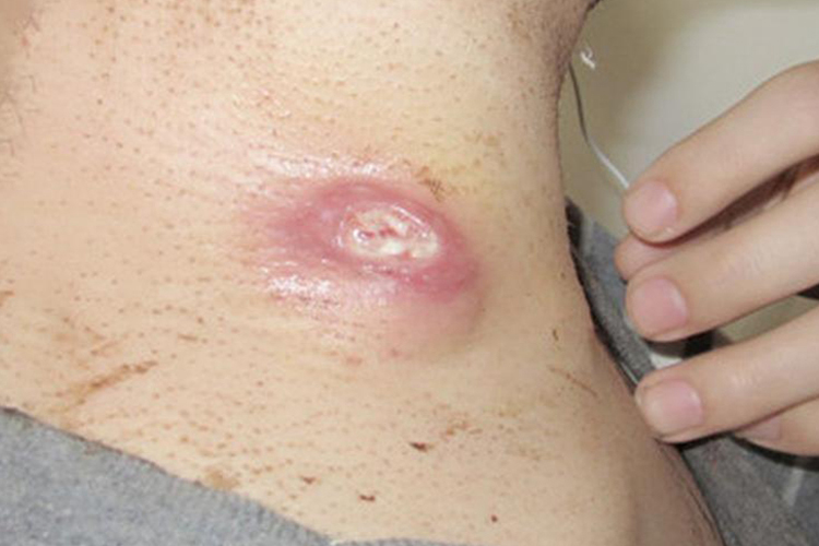 淋巴结核化脓破溃图