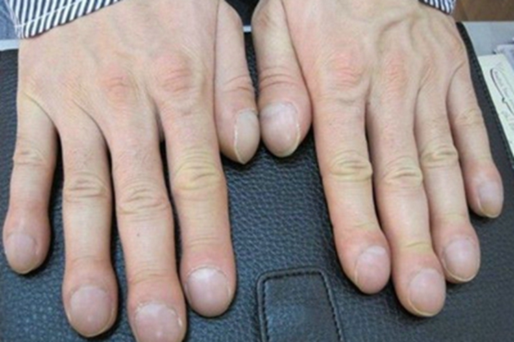 杵状指手指尖增厚图