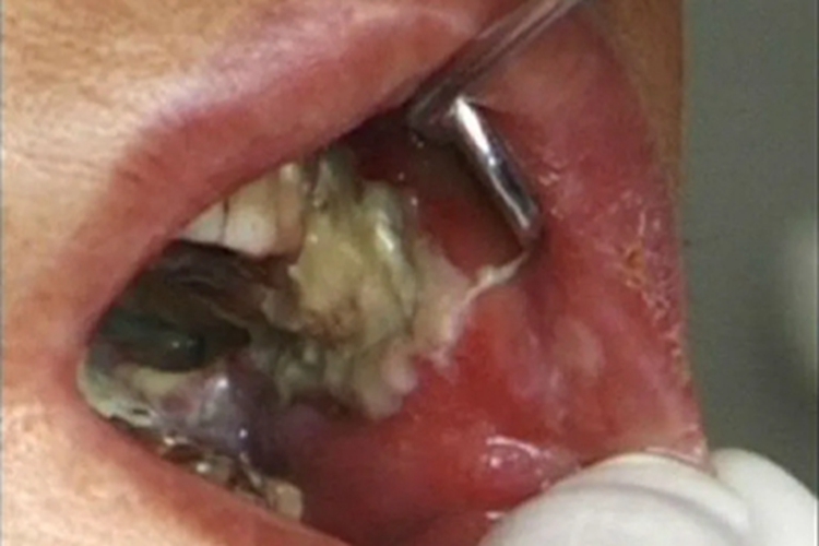 颊癌一边颊黏膜有白斑图 颊癌一边颊黏膜有白斑图