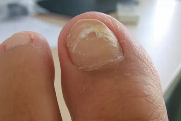 桥本甲状腺炎脚趾甲白斑图