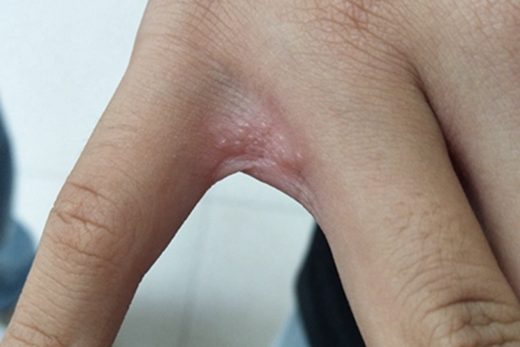 湿疹手指缝症状图