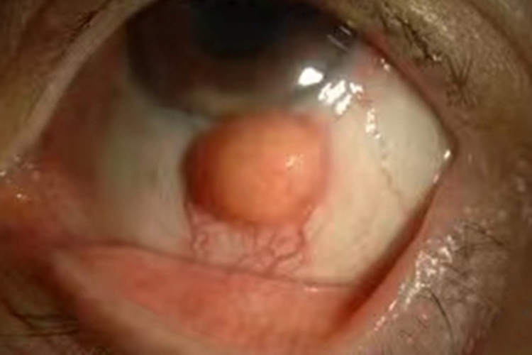 幼年黄色肉芽肿眼部结节图 幼年黄色肉芽肿眼部结节图