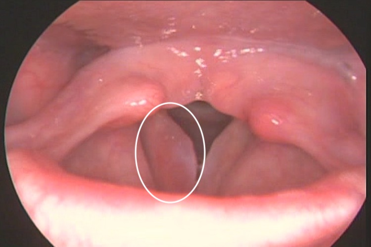 声带水肿图 声带水肿图