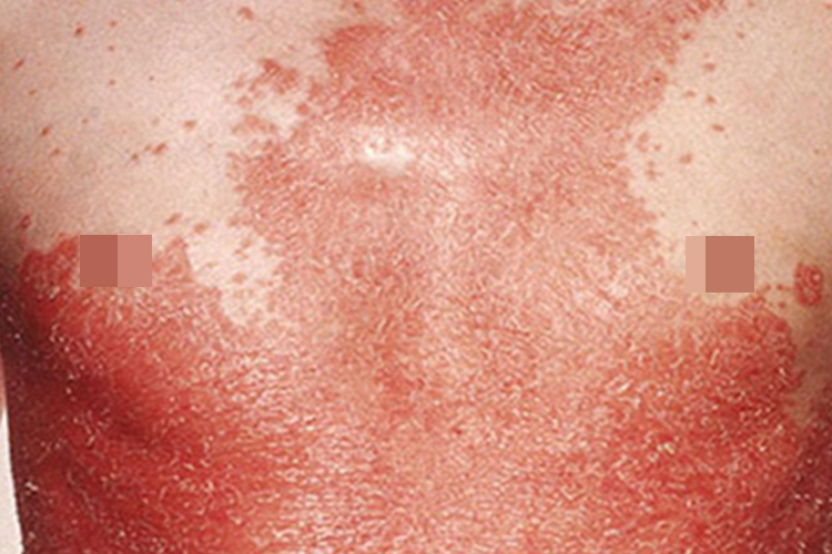 苔藓状淀粉样变胸部脱屑图 苔藓状淀粉样变胸部脱屑图