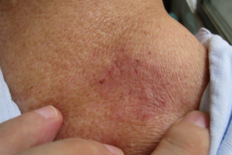 体癣肩部红斑图 体癣肩部红斑图