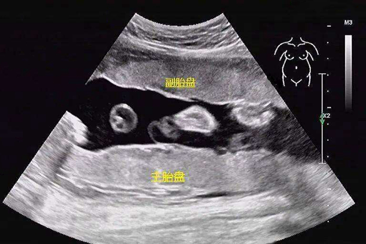 副胎盘影像图