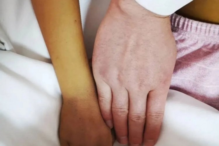 胆汁淤积性黄疸症状图