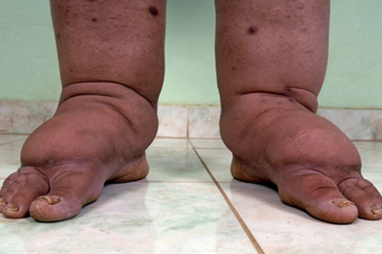 淋巴丝虫病脚部水肿图 淋巴丝虫病脚部水肿图