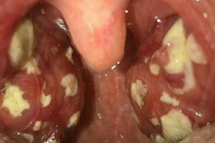 急性化脓性扁桃体炎图