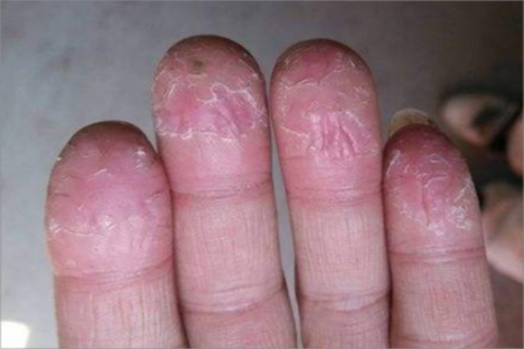 鳞屑角化型手癣手指尖脱屑图