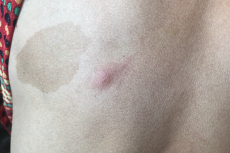 疖背部症状图 疖背部症状图