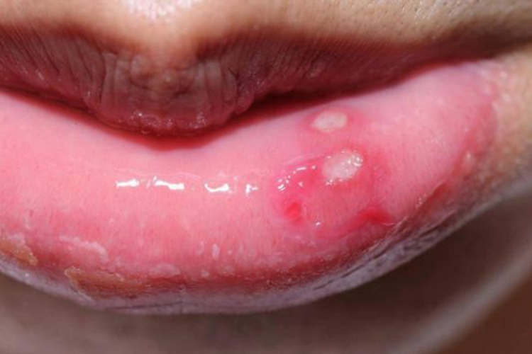 口腔溃疡症状图 口腔溃疡症状图