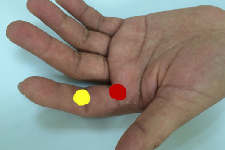 食指腱鞘炎部位图