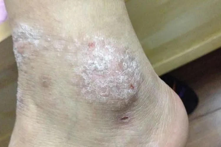 湿疹致脚踝皮肤角质化图 湿疹致脚踝皮肤角质化图