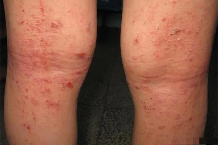 特应性皮炎大腿疙瘩图 特应性皮炎大腿疙瘩图