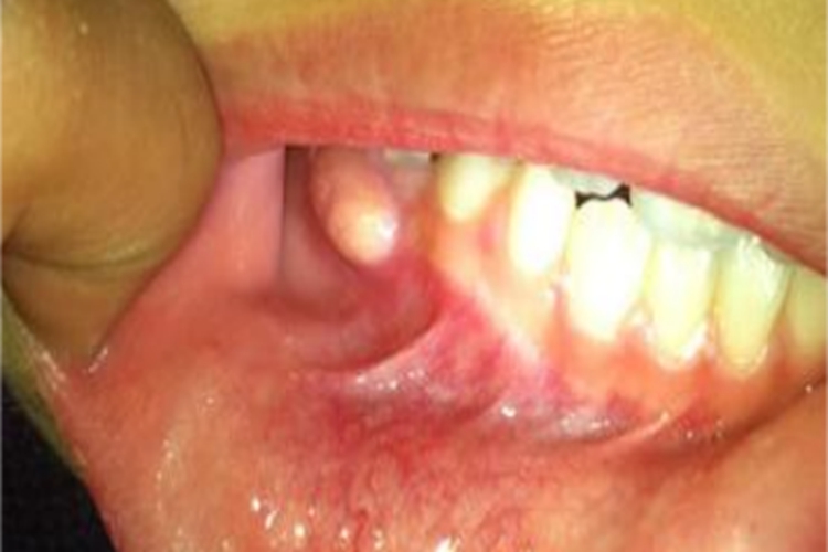 根尖周炎牙龈脓包图