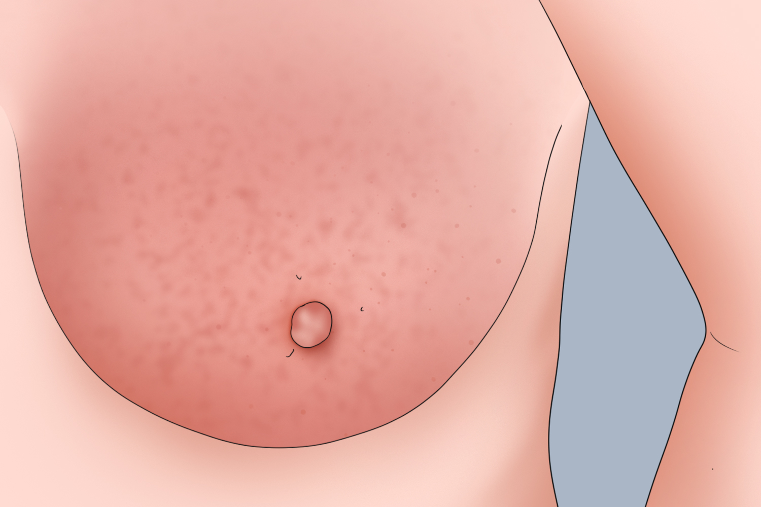 急性乳腺炎乳房红肿手绘图