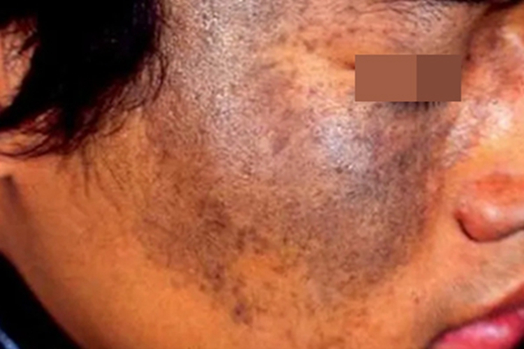 皮肤黑变病右脸有黑色的斑图