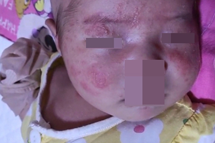 急性湿疹小水疱图