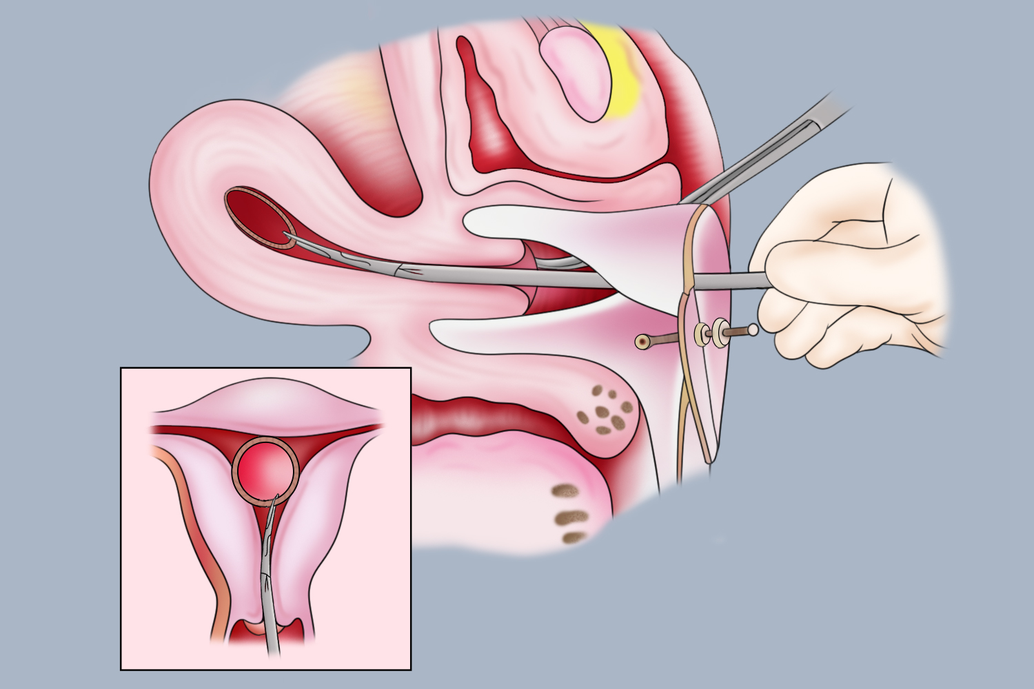 钳取法O型环过程图 钳取法O型环过程图