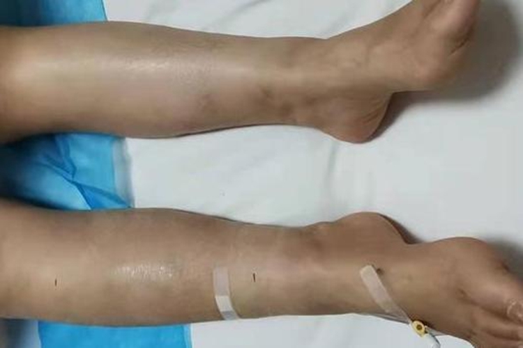 腿部周围型血栓初期图