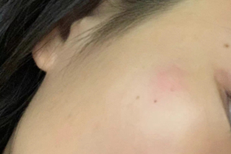 蚊子叮咬脸上起红疙瘩图