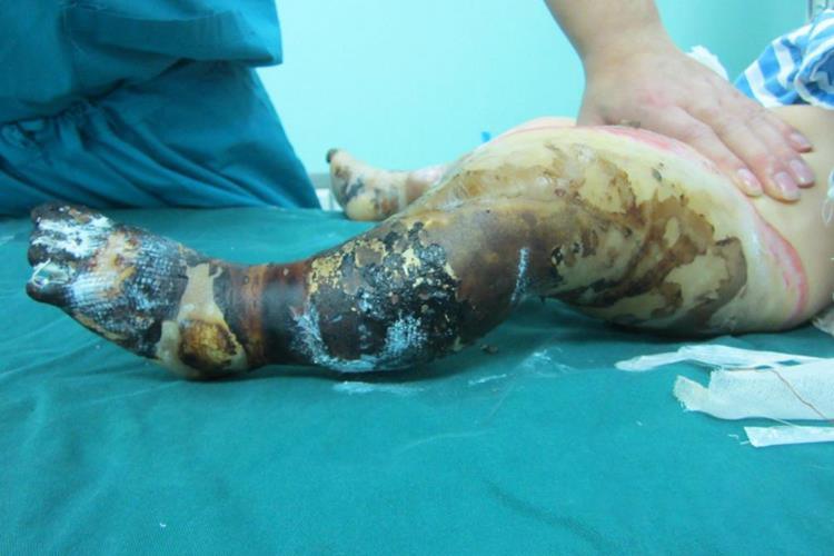 Ⅲ度烧伤皮肤焦痂图 Ⅲ度烧伤皮肤焦痂图