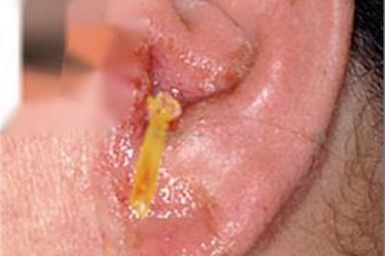 恶性外耳炎耳部化脓图