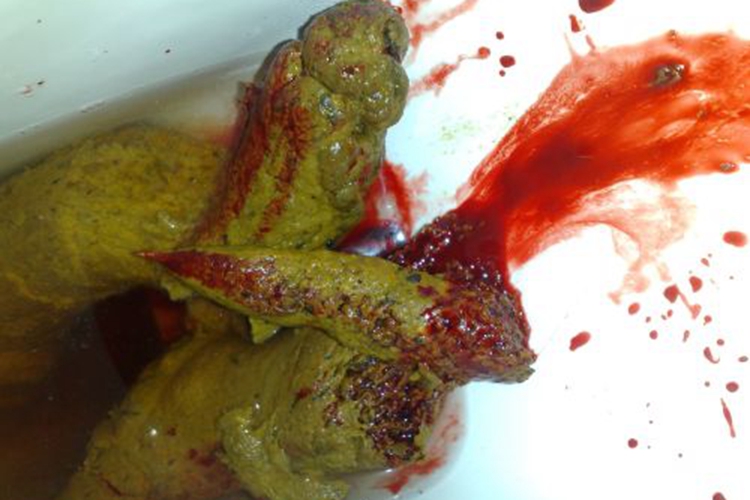 内痔大便有棱角形状图