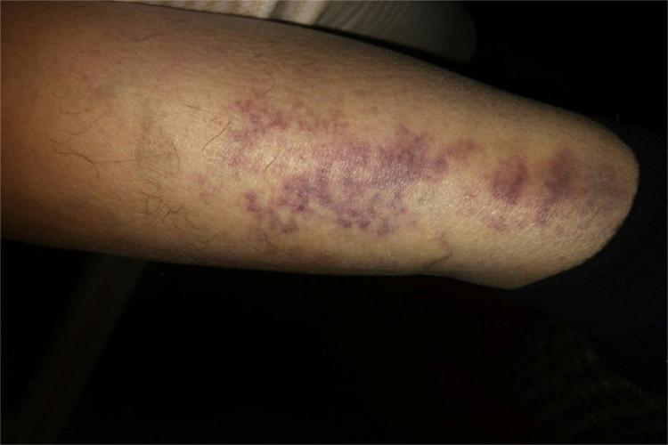 弥漫型类丹毒症状图 弥漫型类丹毒症状图