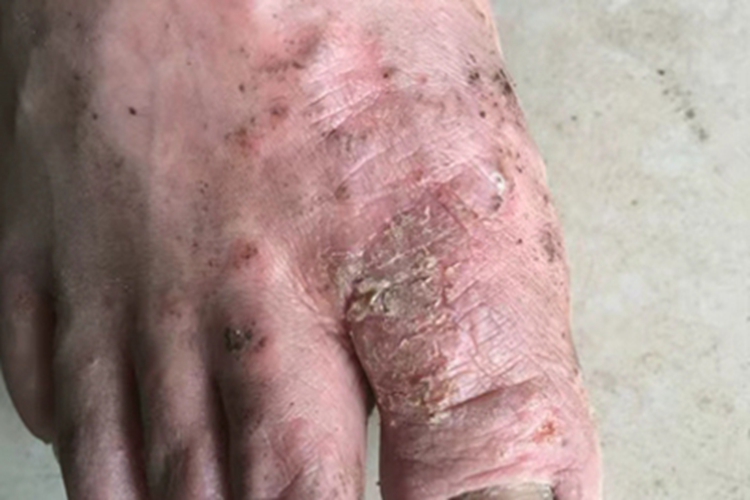 水疱型足癣裂口图 水疱型足癣裂口图