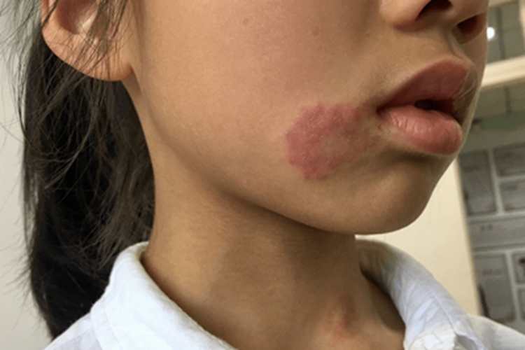 体癣口周症状图