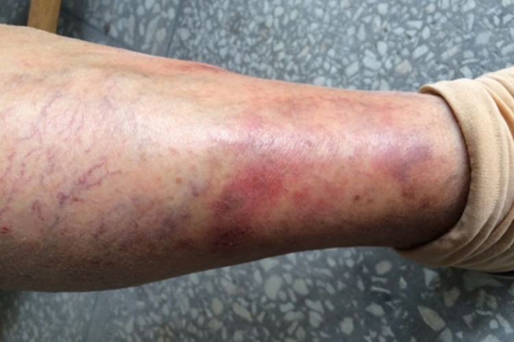 淤积性皮炎小腿皮肤发红图 淤积性皮炎小腿皮肤发红图
