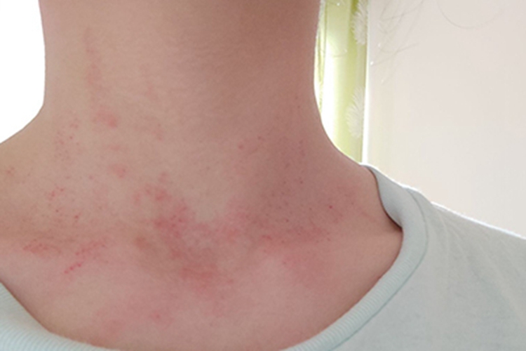 季节性接触性皮炎前颈症状图