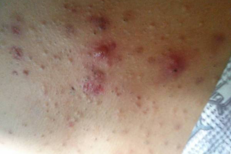 宝宝胸口痤疮图