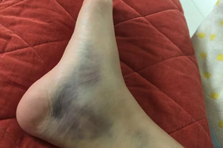 踝扭伤脚踝紫一块青一块图