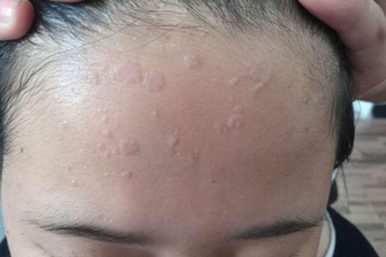 扁平疣前额症状图