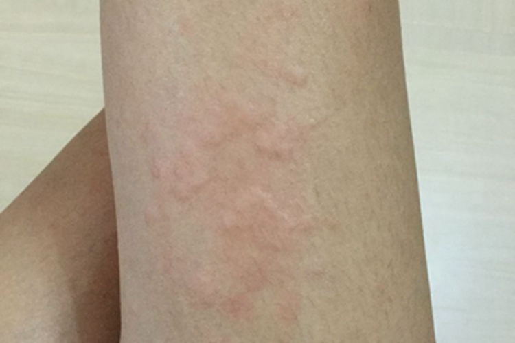 体虱病大腿红色风团图