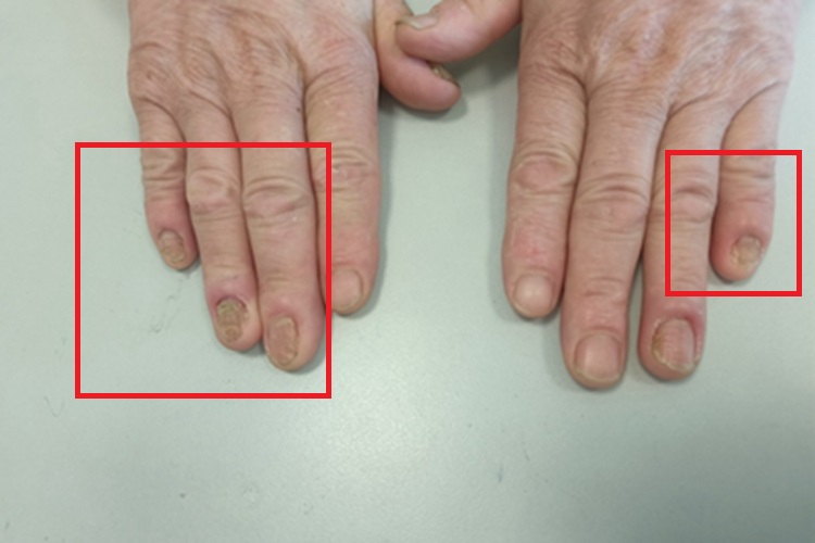 念珠菌性甲真菌病手指甲萎缩图