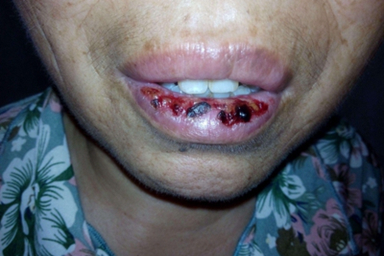 浆细胞性唇炎嘴唇血疱图