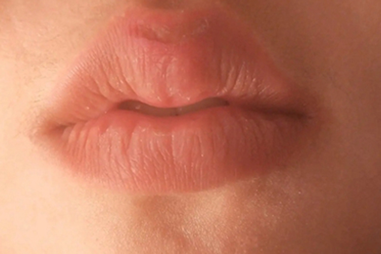 异位皮脂腺嘴唇脱屑图