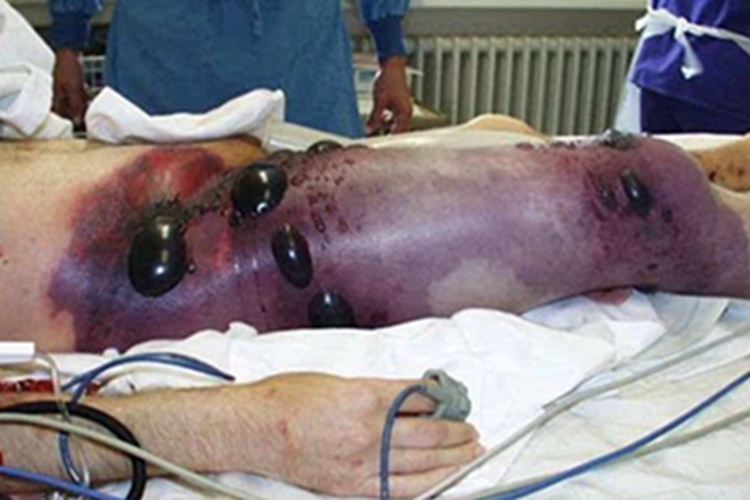 气性坏疽皮肤发黑图 气性坏疽皮肤发黑图