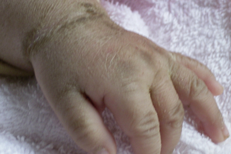 鱼鳞病手腕黑痂图