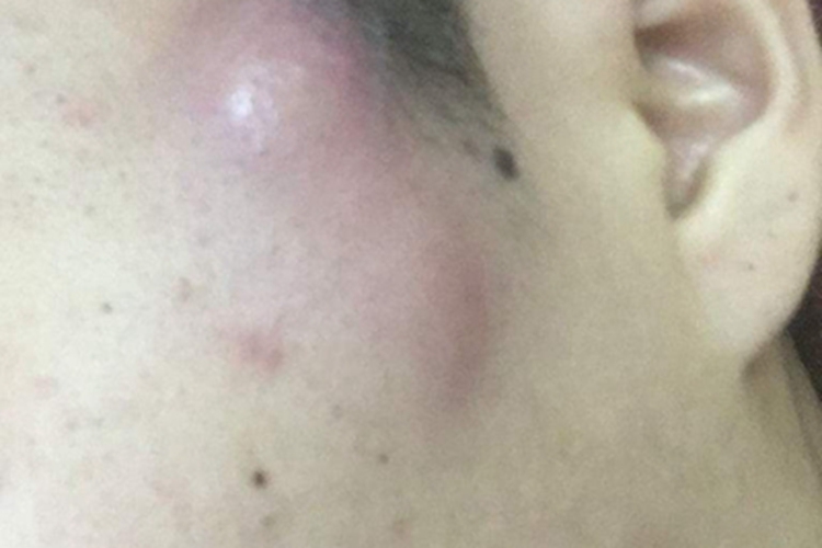 面颈部放线菌病耳前肿块图