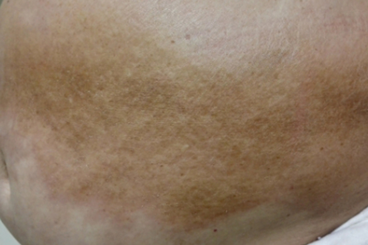 慢性排异皮肤症状图 慢性排异皮肤症状图