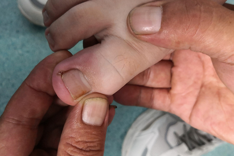 大脚趾急性甲沟炎图